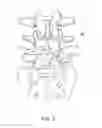 Fig. 02 - Spinal implant system and method