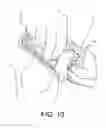 Fig. 08 - Flexible instrument for soft tissue mobilization