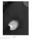 Fig. 04 - HEMOSTATIC PASTE WITH LIGHT-CURABLE FEATURE