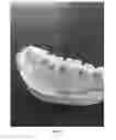 Fig. 06 - HEMOSTATIC PASTE WITH LIGHT-CURABLE FEATURE