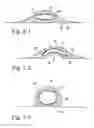 Fig. 23 - Delivery of respiratory therapy