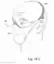 Fig. 44 - Delivery of respiratory therapy