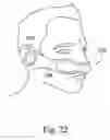 Fig. 71 - Delivery of respiratory therapy