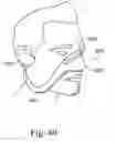 Fig. 89 - Delivery of respiratory therapy