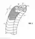 Fig. 03 - SHAPE-TRANSFERRING CANNULA SYSTEM AND METHOD OF USE