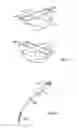 Fig. 20 - SHAPE-TRANSFERRING CANNULA SYSTEM AND METHOD OF USE