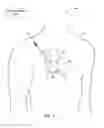 Fig. 02 - Implantable medical device fixation