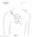 Fig. 02 - Implantable medical device fixation