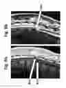 Fig. 09 - Superparamagnetic particle scaffold for regenerating damaged neural tissue