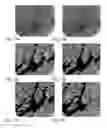 Fig. 64 - Method for treating a cancer patient based on atomic therapeutic indexes and non-radiation therapy