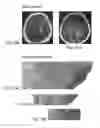 Fig. 76 - Method for treating a cancer patient based on atomic therapeutic indexes and non-radiation therapy
