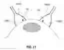 Fig. 09 - Systems and methods for enhancing uptake of therapeutic agent from bloodstream into disease site