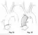 Fig. 09 - Apparatus and method for assisting in hemostasis of a vessel