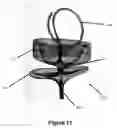 Fig. 07 - Embolic containment