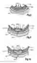 Fig. 07 - More Efficiently and Effectively Removing Stenotic And Restenotic Plaque From Arteries