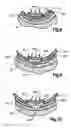 Fig. 07 - Adjustable ring stripper for more efficiently and effectively removing plaque from arteries