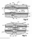 Fig. 09 - Adjustable ring stripper for more efficiently and effectively removing plaque from arteries