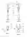 Fig. 06 - Methods and devices for conduit occlusion