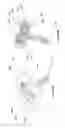 Fig. 04 - Flexible plate fixation of bone fractures