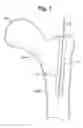 Fig. 02 - Multichannel cannula and methods for using same