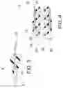 Fig. 04 - Methods of ablating tissue using a catheter injection system