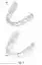 Fig. 02 - Tabbed dental appliance