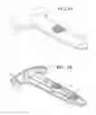 Fig. 02 - METHOD OF TREATING URINARY INCONTINENCE BY IMPLANTING A TRANSVAGINAL MID-URETHRAL SLING INTO A PERSON