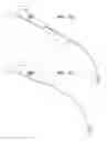 Fig. 07 - METHOD OF TREATING URINARY INCONTINENCE BY IMPLANTING A TRANSVAGINAL MID-URETHRAL SLING INTO A PERSON
