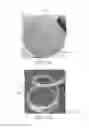 Fig. 37 - Removable deployment device, system, and method for implantable prostheses