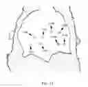 Fig. 20 - Medical fabric with integrated shape memory polymer