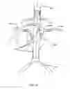 Fig. 09 - Aneurysm Treatment Method