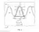 Fig. 04 - Stent-graft having supported transition stent and method