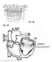Fig. 04 - Device and method for mitral valve regurgitation treatment