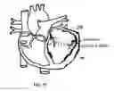 Fig. 12 - Device and method for mitral valve regurgitation treatment