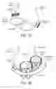 Fig. 09 - Multiple Aperture Sling for Mitral Heart Valves