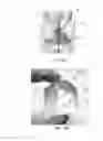 Fig. 06 - Retrievable self-expanding non-thrombogenic low-profile percutaneous atrioventricular valve prosthesis