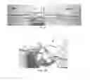 Fig. 07 - Retrievable self-expanding non-thrombogenic low-profile percutaneous atrioventricular valve prosthesis