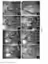 Fig. 10 - Retrievable self-expanding non-thrombogenic low-profile percutaneous atrioventricular valve prosthesis