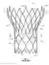 Fig. 02 - Stent cell bridge for cuff attachment