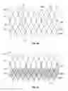 Fig. 07 - Stent cell bridge for cuff attachment