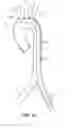 Fig. 06 - SYSTEM FOR DEPLOYING A DEVICE TO A DISTAL LOCATION ACROSS A DISEASED VESSEL