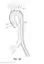 Fig. 08 - SYSTEM FOR DEPLOYING A DEVICE TO A DISTAL LOCATION ACROSS A DISEASED VESSEL