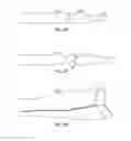 Fig. 72 - SYSTEM FOR DEPLOYING A DEVICE TO A DISTAL LOCATION ACROSS A DISEASED VESSEL