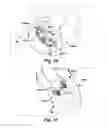 Fig. 07 - Apparatuses and methods for at least partially supporting a valve leaflet of a regurgitant heart valve