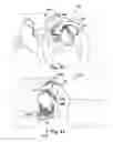 Fig. 09 - Apparatuses and methods for at least partially supporting a valve leaflet of a regurgitant heart valve