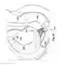 Fig. 22 - Apparatuses and methods for at least partially supporting a valve leaflet of a regurgitant heart valve