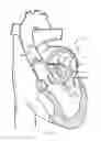 Fig. 22 - Multi-channel apparatus for delivering a constricting cord or a ring to a cardiac valve annulus