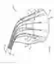 Fig. 09 - Preventing tissue ingrowth into constricting cords after implantation