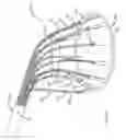 Fig. 10 - Preventing tissue ingrowth into constricting cords after implantation