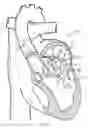 Fig. 22 - Preventing tissue ingrowth into constricting cords after implantation